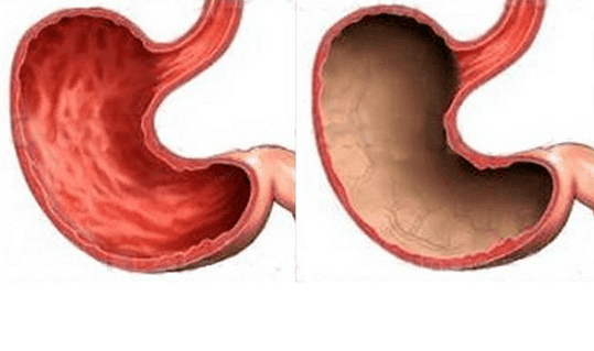Ulcer, gastritis, cancer, and other stomach disorders (right) whose appearance was caused by alcohol